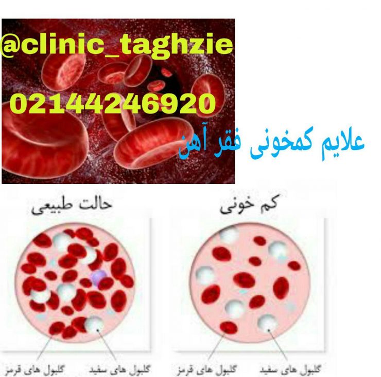 علائم کم خونی