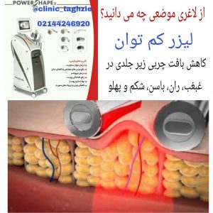 لاغری موضعی