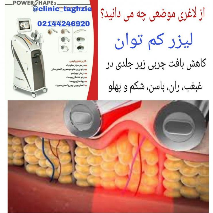 لاغری موضعی